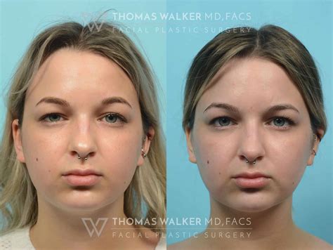 buccal fat removal norge|Buccal Fat Reduction .